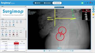 Using Surgimap for measuring sagittal alignment and osteotomy planning [upl. by Ahter794]