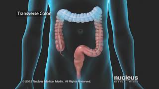 Colon Problems Diverticular Disease [upl. by Yert]