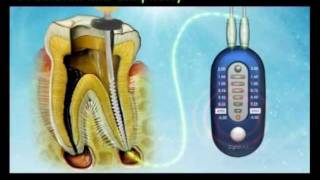 MedicNRGs Digital Apex Locatorswmv [upl. by Aierbma538]