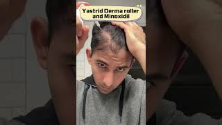 How to use derma roller for hair growth treatment [upl. by Ilecara172]