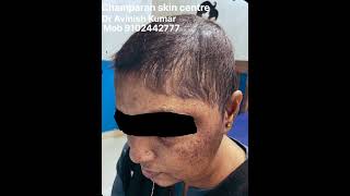 alopecia alopeciatotalis hair shorts reels viralvideo viralshorts maharshtra bihar [upl. by Cecilio835]