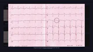 First Degree Atrioventricular Block ECG [upl. by Anatnahs]