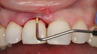 How to Get Rid of a Tooth Abscess Without Going to the Dentist [upl. by Andre]