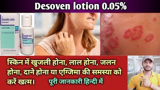 Desowen lotion use dose benefits and Side effects full review in hindi [upl. by Ahsinauj125]