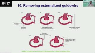 Retrograde CTO PCI Tips amp Tricks Wire Externalization by Dr Aftab khan [upl. by Nashbar]