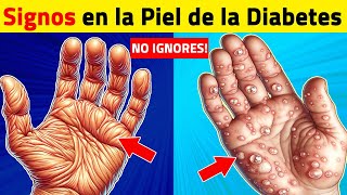 8 Signos Comunes de la Diabetes en la Piel [upl. by Ahseyt]