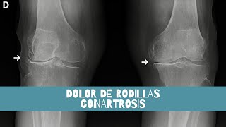 DOLOR DE RODILLAS Gonartrosis Osteoporosis MUJER DE 86 AÑOS [upl. by Rehpotsrik567]