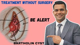 Bartholin Cyst Treatment Without Surgery  Bartholin Cyst Different Stages and Natural Treatment [upl. by Lamp45]