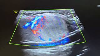 Ultrasound of hyperplastic adenomatous nodule in right lobe of thyroid [upl. by Ferullo]