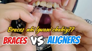 Teeth gap best treatment  🇵🇰😃 Aligners vs metal Braces  cost of Aligners and braces in Pakistan [upl. by Monto235]