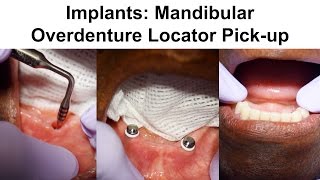 2 Implants Mandibular Overdenture Locator Pickup [upl. by Enajaras]