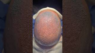 Norwood 7 transformation Hair transplant postop hairtransplant vincihairclinic shorts [upl. by Wootan]