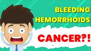 Can Hemorrhoids Be A Sign of Cancer  Best Hemorrhoids amp Piles Answers [upl. by Vanni]