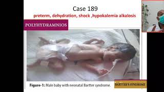 Case 189 hypokalemic metabolic alkalosis Bartter syndrome hyperprostaglandin Syndrome hypercalciu [upl. by Wetzel71]