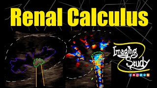 Renal Calculus  Nephrolithiasis  Ultrasound  Case 274 [upl. by Ten913]