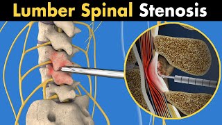 MILD procedure of lumber spinal stenosis 3D animation [upl. by Auqinat930]