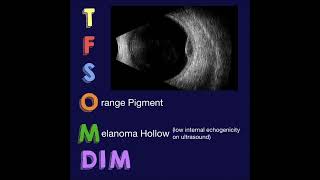 TFSOM DIM Risk Factors for Choroidal Nevus Growth to Melanoma [upl. by Anonyw710]