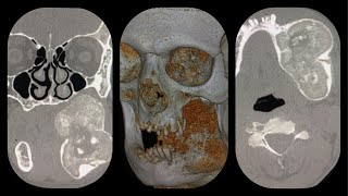 mandibular fibrous dysplasia CT scan and 3D reconstruction [upl. by Dominic]