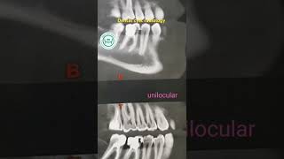 Dental cyst radiology حويصلات الفكين [upl. by Wayland]