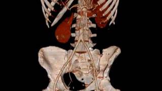 iradka CT 3D floating kidney Wanderniere Senkniere Radiologie Karlsruhe [upl. by Leuqram]