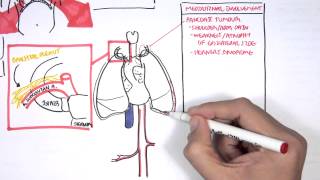 Lung Carcinoma Lung cancer [upl. by Ignacia600]