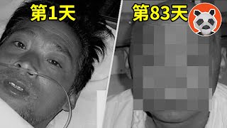 核輻射死亡83天全紀錄，看著自己融化是種什麼體驗？他遭受2萬倍的輻射量，世界上死的最慘的人【🐼熊貓周周】 [upl. by Lenad703]