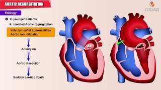 Aortic regurgitation  Aortic insufficiency  Etiology  Pathology  Diagnosis and Treatment USMLE [upl. by Cirdla443]