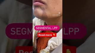 Segmental lichen Planus Pigmentosus Treatment drashimagoel skincare parisaskinclinic [upl. by Nehtiek708]