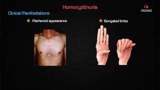 Homocystinuria  Usmle step 1 biochemistry Webinar based lecture [upl. by Llechtim726]