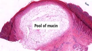 Pathology of Digital Mucous Myxoid Cyst by Dr Sampurna Roy MD  dermatopathology dermpath [upl. by Bernard]