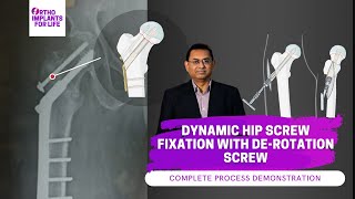 Dynamic Hip Screw Fixation with De Rotation Screw Procedure [upl. by Nywra]