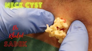 Never Ending Cyst Dr Khaled Sadek LipomaCystcom [upl. by Sibelle]