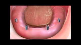 Implant Supported Dentures [upl. by Hyland]