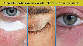 Atopic Dermatitis on the eyelids – The causes and symptoms  Nuse Healthy [upl. by Petulia]