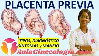 PLACENTA PREVIA CLASIFICACIÓN DIAGNÓSTICO 🩸SÍNTOMAS🩸 MANEJO  Ginecología y Obstetricia [upl. by Caz]