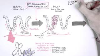 Colon Cancer Carcinogensis [upl. by Marielle]