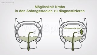 Blasenkrebs – Diagnose und Untersuchungen [upl. by Puto528]