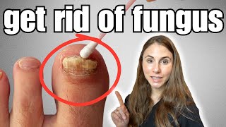 Get Rid Of Toenail Fungus With These 4 Easy Home Remedies [upl. by Madison]