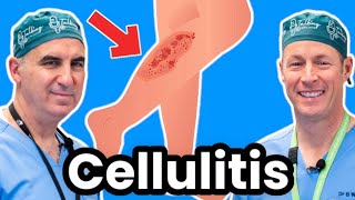 Cellulitis Explained By Infectious Disease Doc Red Sore And Swollen [upl. by Caines26]