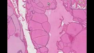 Histopathology ThyroidColloid goiter [upl. by Alleras390]