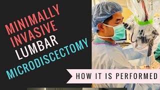 Minimally Invasive Lumbar Microdiscectomy Video  How Its Performed [upl. by Auqinihs809]