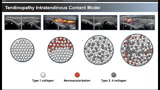 Tendinosis and the role of Minimally Invasive Tenotomy [upl. by Geof636]
