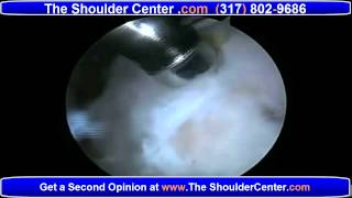 Failed Rotator Cuff Surgery  Options for Rotator Cuff Revision ReTears [upl. by Kowatch441]