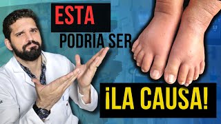 ¡MIRA ¿Por qué tus PIERNAS se HINCHAN ¡Descubre las posibles causas y SOLUCIONES✅ [upl. by Aimak60]