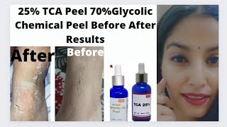 25 TCA peel 70 Glycolic peel Before After Results HandLegsBody Chemical peelIn Hindi [upl. by Arem]