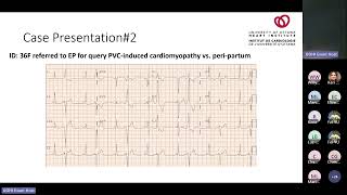 Frequent Ventricular Ectopy Defining Outcomes When and How to Treat with Michael Thibert MD [upl. by Fisken]