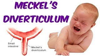 Meckels Diverticulum [upl. by Lorilee706]