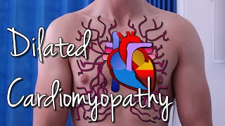 Dilated Cardiomyopathy [upl. by Hollenbeck]