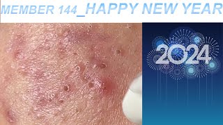 Acne Treatment Huong Da Nang 144  Member Happy New Year [upl. by Bergeman]