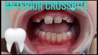 Anterior crossbite malocclusion and displacement lingual to their original erupting positions [upl. by Lowrance]